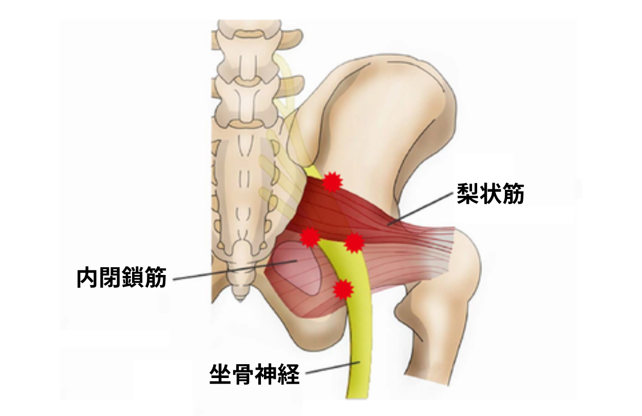 梨状筋症候群の図解
